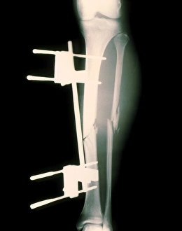 Drucke von Pinned gebrochener Knieschaft. Röntgenbild eines pinnten Knochenbruchs beider Tibia und Fibula (Unterknieknochen) Bilder Datiert 2002 Dezember: Verletztes Bein im Gips