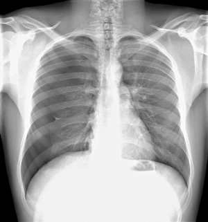 Pneumothorax, Röntgenbild