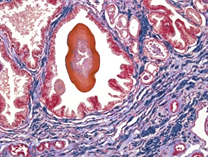 Drucke von Prostata. Lichtmikroskopische Abbildung einer Schnittfläche der Prostata, die eine Konkretion (rot) von sekretenhaltigen Materialien in einem prostatären Alveolus (Luftraum) zeigt Bilder Datiert 2010 September: Prostata, lebendiger Mikroskopbild