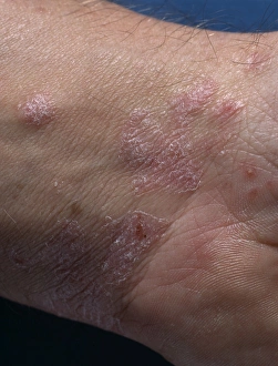 Drucke von Psoriatishäutlichkeiten an der Haut eines Mannes am Handgelenk Bilder Datiert 2003 Juni: Psoriasis