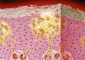 Psoriasis