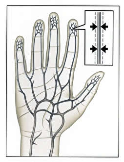 Drucke von Raynauds-Krankheit: Kunstwerk einer von Raynauds Krankheit betroffenen Hand mit blutenden Venen (grau). Die Haut ist schwarz und die Fingernägel sind gelblich Bilder Datiert 2002 September: Raynaud's Krankheit