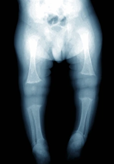Drucke von Rickettsche Krankheit. Röntgenaufnahme der Beine eines jungen Kindes mit Rickettsche Krankheit Bilder Datiert 2011 August: Rickets - Röntgenbild