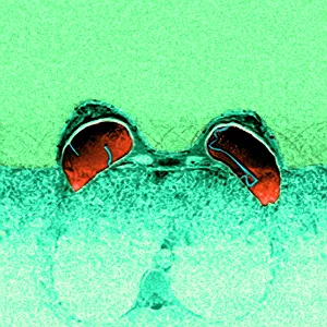 Drucke von Rissbehaftete Brustimplantate. Farbige Magnetresonanzbildgebung (MRI)-Scans von Rissen in beiden Frauenbrüstenimplantaten (rot). Diese sind die intrakapsulären Risse, die häufigste Art Bilder Datiert 2004 Oktober: Klatschende Brustimplantate, MRI