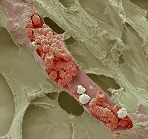 Drucke von Rissene Venulä, farbiges Scanning-Elektronen-Mikroskopbild einer gerissenem Venula durch fettes Gewebe Bilder Datiert 2011 Dezember: Zerstorte Venelochse, SEM