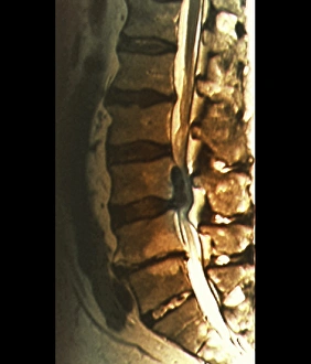 Bilder Datiert 27. März 2013: Sciatica, MRT-Scan