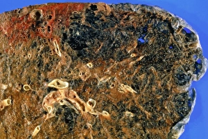 Bilder aus dem Jahr 1993: Emphysämatose betroffener Lungenabschnitt