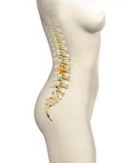 Back Pain Causes Drucke: Slipped disc, artwork