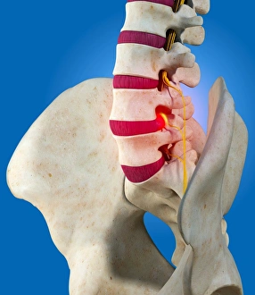Drucke von Ein rissiger Intervertebral-Disk, Computerkunstwerk. Die intervertebralen Diske (rot) sind Platten aus Knorpel zwischen den Knochen der Wirbelsäule Bilder Datiert 2009 Februar: Verletzter Bandscheibe im Rücken, Kunstwerk
