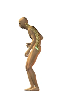 Vertebral Column Illustration Drucke: Spinal disorder, artwork
