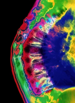 Osteoporosis Symptoms Drucke: Spinal osteoporosis