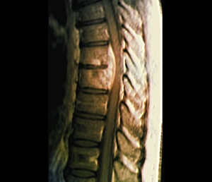 Bilder Datiert 27. März 2013: Spondylosidozitis, MRT-Scan