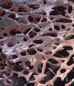 Drucke von Spongy Knochen. Farbiger Rasterton Mikroskop (SEM)-Bild des spongiösen humanen Knorpels aus dem Schaft eines langen Knochens, der unter einer dichten Schale von hartem festem Knochen gefunden wird Bilder Datiert 2002 März: Weichknochengewebe, SEM