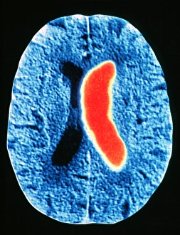 Computed Tomography Scans Drucke: Stroke