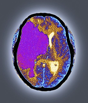 Bilder Datiert 4. März 2013: Schlag, Computertomographie