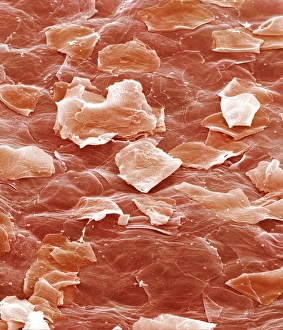 Drucke von Sonnenbrandige Haut. Farbenerganzung (SEM) der epidermalen Hautzellen nach Sonnenschlag Bilder Datiert 2003 April: Sonnenverbranntes Haut