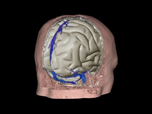 Drucke von Thrombophlebitis im Gehirn Bilder Datiert 2013 April: Thrombophlebitis im Gehirn mit 3D-CT-Schnittbild