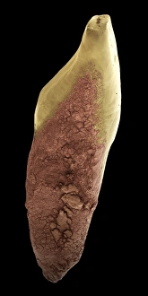 Drucke von Zahnverfall. Farbiges Scanning-Elektronen-Mikroskopbild (SEM) von Zahnplaque (braun) auf einem menschlichen Vorderzähne. Die Plaque ist ein Film aus Bakterien im Glykopeptidmatrix eingeschlossen Bilder Datiert 2006 Mai: Zahnrissbildung durch SEM