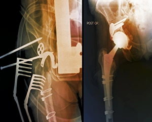 Hip Replacement Surgery Drucke: Total hip replacement, X-rays