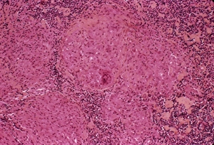 Mycobacterium Tuberculosis Bacteria Drucke: Tuberculosis, light micrograph C015 / 6400