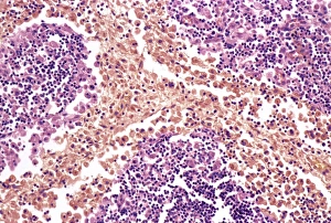 Drucke von Typhoide Knoten, farbiger Lichtmikroskopbild. Schnitt durch ein Lymphknoten eines Patienten mit Typhus, zeigt Makrophagen (große Zellen rosa) die Typhoide Knoten bilden Bilder Datiert 2008 April: Typhus Knoten, lebendige Mikroskopie