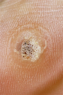 Drucke von Eine verruca (oder Plantarwart), ein kleiner harmloser Wuchs in der Haut, verursacht durch eine Vireninfektion Bilder Datiert 2004 November: Verruca