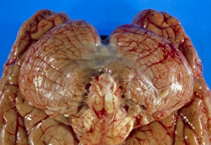 Drucke von Meningitis. Blick auf die Unterseite eines menschlichen Gehirns infiziert mit einer Meningitiskrankheit. Die untere Mitte des Gehirnstems ist sichtbar (links) Bilder Datiert 2003 September: Blick auf die Unterseite des Gehirns mit Meningitis