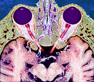 Human Eye Anatomy Drucke: Vision and the brain, MRI scan