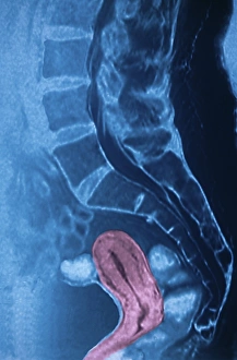 Female Reproductive System Drucke: Womb, CT scan