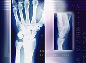 Gelenknochen des Handgelenks (Röntgenbild)