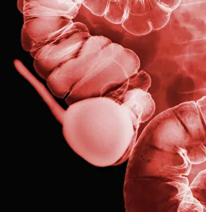 Bilder Datiert 2012 April: Röntgenbild des Appendix