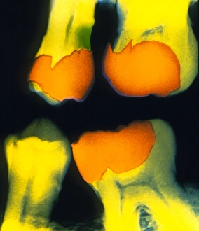 Dental X Ray Drucke: X-ray of teeth