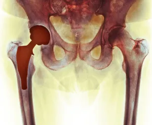 Gesamtkopfprothese mit Röntgenaufnahme