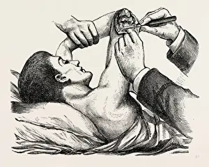 Medical Equipment History Drucke: excision of the elbow, the clearing of the humerus, medical equipment, surgical instrument