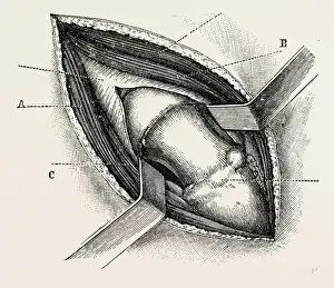 Medical Equipment History Drucke: excision of the hip by an external incision, medical equipment, surgical instrument