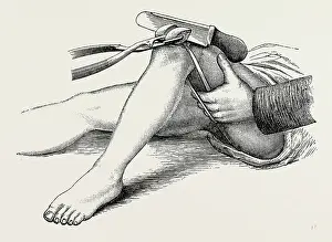 Medical Equipment History Drucke: excision of the knee, the sawing of the lower end, medical equipment, surgical instrument