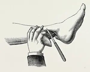Medical Equipment History Drucke: mode of dividing the tissues in the amputation, medical equipment, surgical instrument