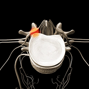 Human Spine Anatomy Drucke: A herniated disc pressing against a spinal nerve