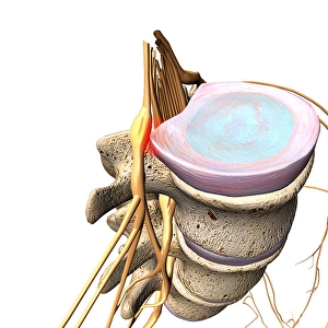Biomedical Illustration Of Spine Drucke: A herniated disc pressing against a spinal nerve