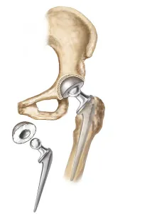 Hip Replacement Surgery Drucke: Detail of hip replacemnt