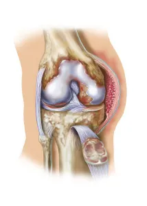Knee Joint Anatomy Drucke: Front view of knee joint opened to show pannus