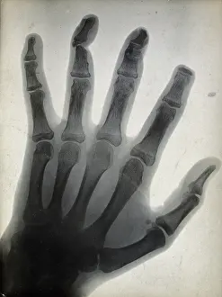 Black And White Medical Images Drucke: The bones of a hand, with the tip of the index finger missing, viewed through x-ray, 1896