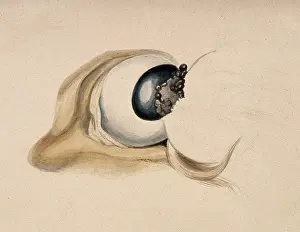 Anatomy Of The Eye Drucke: A diseased eye. Creator: Unknown