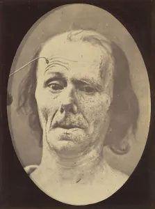 Figur 9: Eine Studie zur M. Frontalis bei Maximalverkontraktionen von 1854 bis -56, gedruckt im Jahr 1862