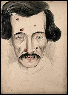 British Medical History Drucke: Head of a man with a disease affecting his face