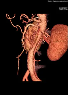ANEURYSMA DER AORTA, 3D-SCAN