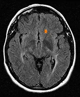 Braunkopf-CT-Schnittstelle mit Multipler Sklerose
