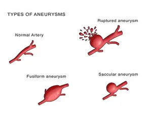 Arterienaneurysmen, Venenaneurysmen und Arteriosklerose mit Blutungen aus den Aorten oder ihren Nebengelenken