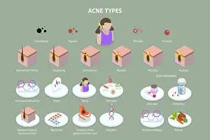 Personal Hygiene Importance Drucke: 3D Isometric Flat Vector Conceptual Illustration of Acne Types