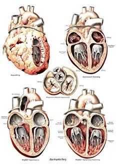 Human Heart Anatomy Drucke: Anatomy, human, various pathological changes of the human heart